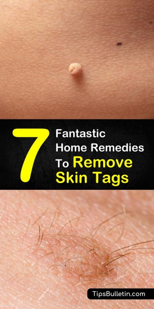 7 Fantastic Home Remedies To Remove Skin Tags destiné Skin Tag Removal Chennai