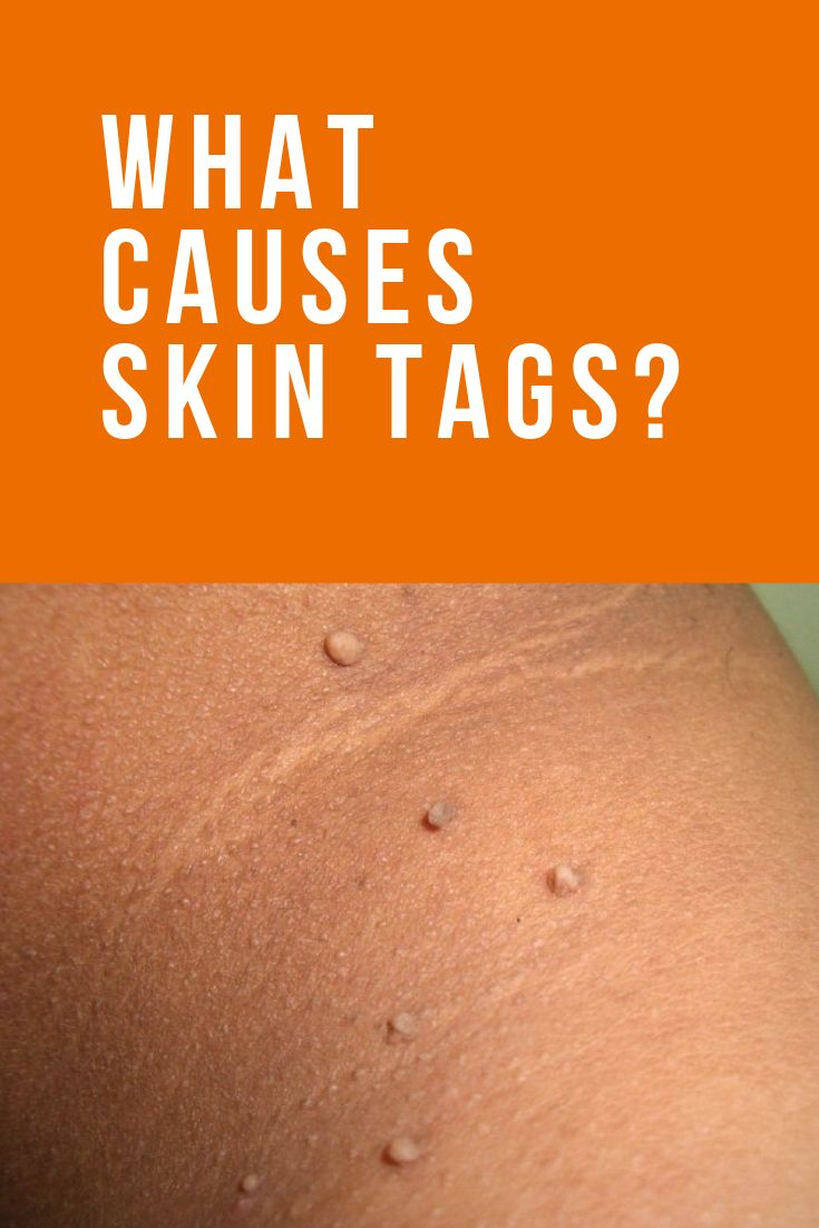 Pin On Skin Conditions tout Skin Tag Removal Chennai