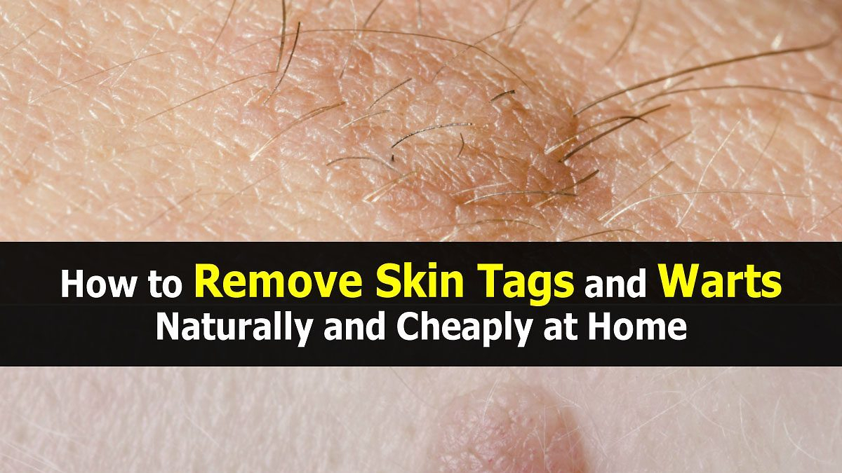 Skin Tag And Wart Removal — 3 Simple Home Remedy Wart pour Skin Tag Removal Chennai