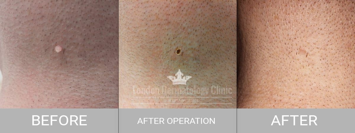 Skin Tag Removal (Same Day £159) | London Dermatology Clinic tout Skin Tag Removal Chennai