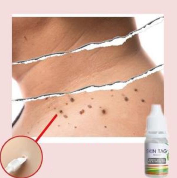 Skin Tag Remover - Not Sold In Stores avec Skin Tag Removal Chennai