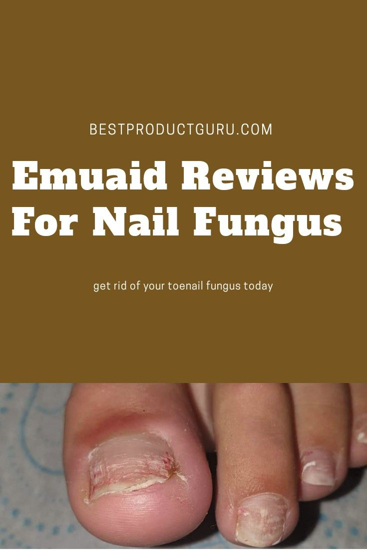 Emuaid Reviews For Nail Fungus | Nail Fungus, Toenail tout Emuaid Reviews