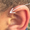 Hole In Ear Causes, Signs, Symptoms, Diagnosis, Treatment &amp; Prognosis avec 3 Trous Lobe Oreille