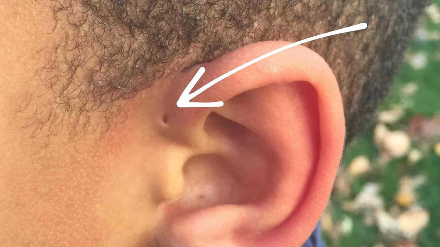 Hole In Ear Causes, Signs, Symptoms, Diagnosis, Treatment &amp;amp; Prognosis avec 3 Trous Lobe Oreille